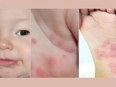 Cảnh báo sớm qua hình ảnh bệnh tay chân miệng cấp độ 1