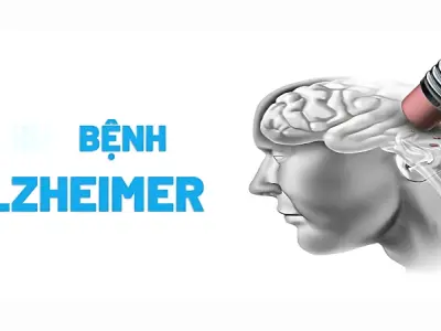 Nhận diện hình ảnh bệnh Alzheimer qua giai đoạn đầu