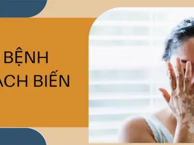 Hình ảnh bệnh bạch biến và triệu chứng nhận biết sớm