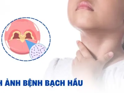 Hình ảnh bệnh bạch hầu rõ nét giúp nhận biết triệu chứng