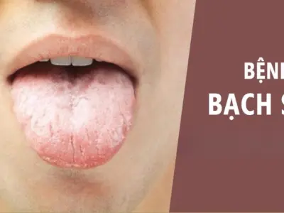 Nhận biết sớm qua hình ảnh bệnh bạch sản lưỡi chi tiết