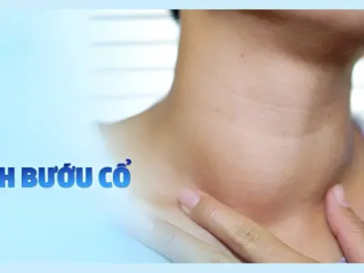 Tổng hợp hình ảnh bệnh bướu cổ từ nhẹ đến nặng