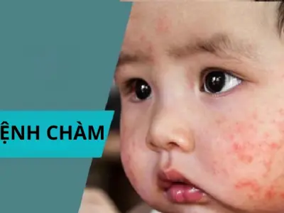 Chi tiết hình ảnh bệnh chàm ở trẻ em từ nhẹ đến nặng