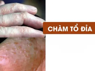 Hình ảnh bệnh chàm tổ đỉa và dấu hiệu dễ nhận biết