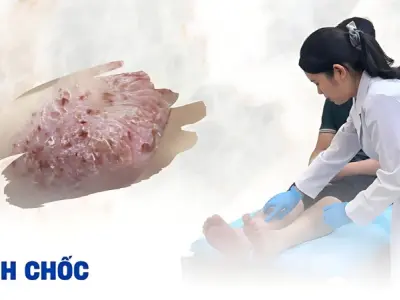 Hình ảnh bệnh chốc thường gặp ở trẻ em và người lớn