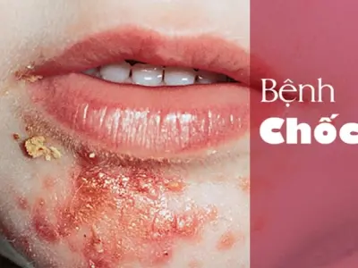 Cập nhật mới nhất về hình ảnh bệnh chốc lở nguy hiểm