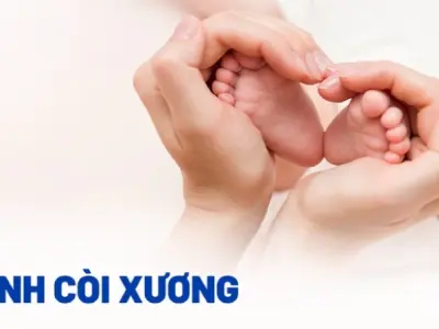 Hình ảnh bệnh còi xương điển hình giúp phụ huynh dễ nhận ra