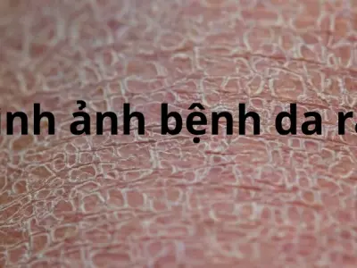 Bộ sưu tập hình ảnh bệnh da rắn dễ nhận biết tại nhà