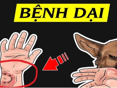 Hình ảnh bệnh dại chi tiết qua từng giai đoạn nguy hiểm