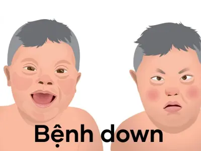 Dấu hiệu đặc trưng qua hình ảnh bệnh Down thực tế