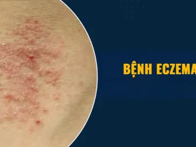 Nhận biết sớm qua hình ảnh bệnh eczema theo từng giai đoạn