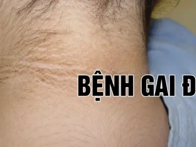 Nhận biết bệnh sớm qua hình ảnh bệnh gai đen thực tế