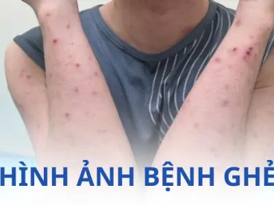 Tổng hợp hình ảnh bệnh ghẻ thật giúp bạn dễ nhận diện