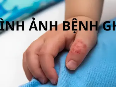 Hình ảnh bệnh ghẻ ở trẻ em giúp nhận biết sớm và chữa trị