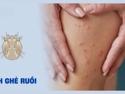 Nhận biết qua hình ảnh bệnh ghẻ ruồi ở người lớn và trẻ