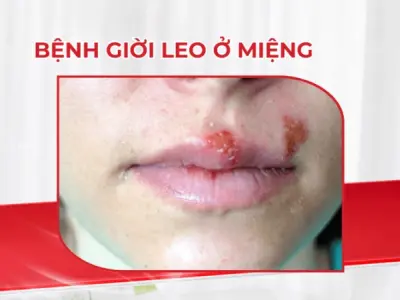 Tổng hợp hình ảnh bệnh giời leo ở môi dễ nhận biết