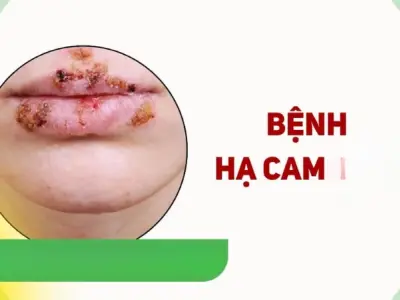 Hình ảnh bệnh hạ cam rõ nhất giúp nhận biết sớm triệu chứng