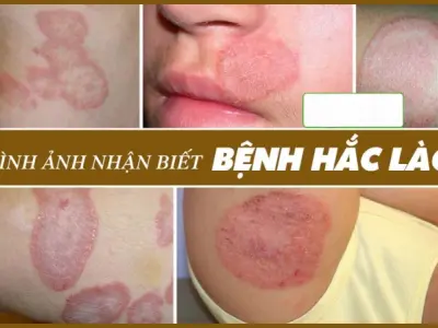 Nhận biết sớm qua các hình ảnh bệnh hắc lào thực tế