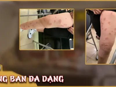 Tổng hợp hình ảnh bệnh hồng ban đa dạng trên cơ thể người