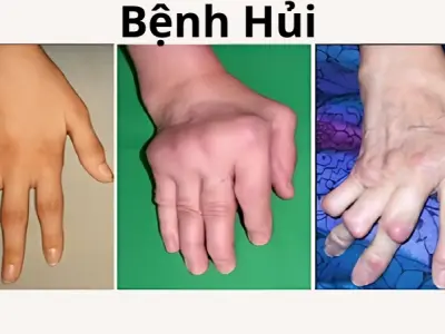 Tổng hợp hình ảnh bệnh hủi chi tiết từ nhẹ đến nặng