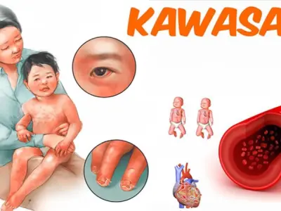 Hình ảnh bệnh Kawasaki giúp chẩn đoán sớm hiệu quả