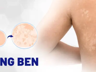 Nhận biết sớm qua hình ảnh bệnh lang beng phổ biến