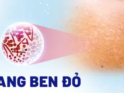 Hình ảnh bệnh lang beng đỏ trên da và cách phân biệt