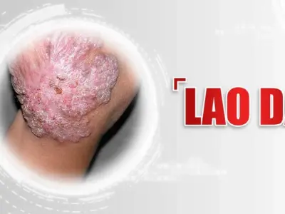 Tổng hợp hình ảnh bệnh lao da qua các giai đoạn thường gặp