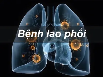 Hình ảnh bệnh lao phổi thực tế từ phim chụp X-quang