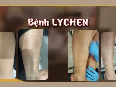 Tổng hợp hình ảnh bệnh lichen thường gặp trên da người