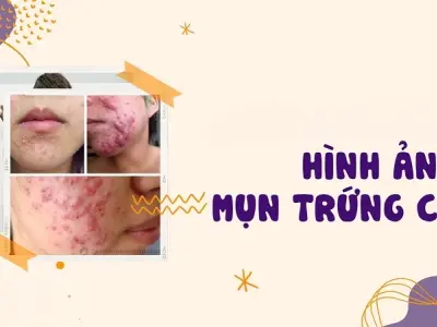 Tổng hợp hình ảnh bệnh mụn trứng cá từ nhẹ đến nặng