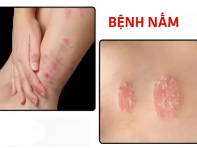 Tổng hợp hình ảnh bệnh nấm thường gặp ở người và da