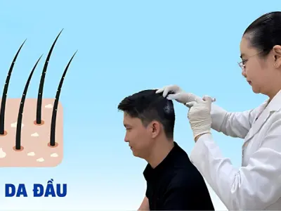 Hình ảnh bệnh nấm da đầu chi tiết theo từng giai đoạn