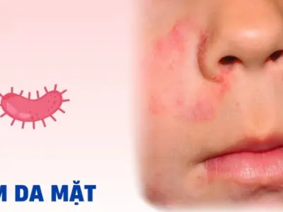 Nhận biết bệnh qua hình ảnh bệnh nấm da mặt thực tế