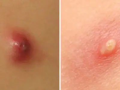 Tổng hợp hình ảnh bệnh ổ gà ở nách giúp nhận biết chính xác
