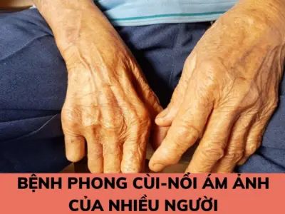 Tổng hợp hình ảnh bệnh phong cùi ở giai đoạn đầu rõ nét