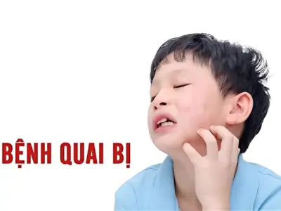 Hình ảnh bệnh quai bị ở trẻ em và người lớn chi tiết nhất