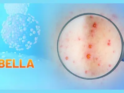 Hình ảnh bệnh rubella dễ nhận biết qua từng giai đoạn