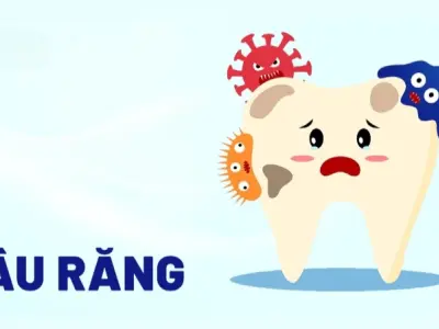 Nhận biết bệnh qua hình ảnh bệnh sâu răng thực tế