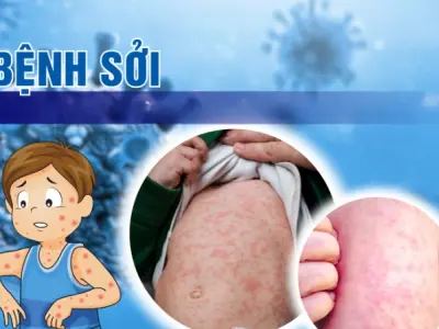 Hình ảnh bệnh sởi trẻ em qua từng giai đoạn phát triển