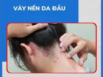 Nhận biết sớm qua hình ảnh bệnh vảy nến da đầu