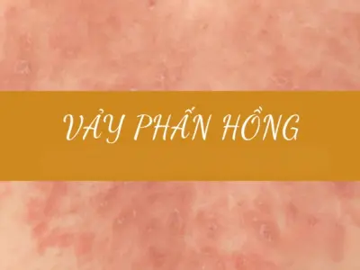 Tổng hợp hình ảnh bệnh vảy phấn hồng chi tiết dễ nhận biết