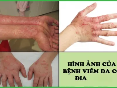 Nhận biết sớm qua hình ảnh bệnh viêm da cơ địa điển hình
