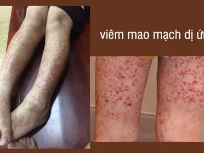 Phân tích hình ảnh bệnh viêm mao mạch dị ứng dễ hiểu nhất