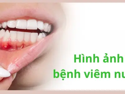 Hình ảnh bệnh viêm nướu chi tiết giúp nhận biết sớm