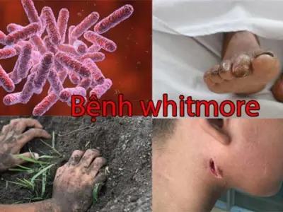 Phân biệt hình ảnh bệnh Whitmore với bệnh ngoài da