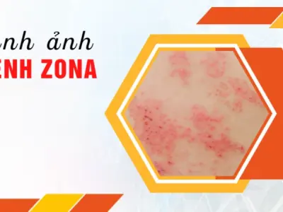 Cẩm nang nhận biết qua hình ảnh bệnh zona chi tiết nhất