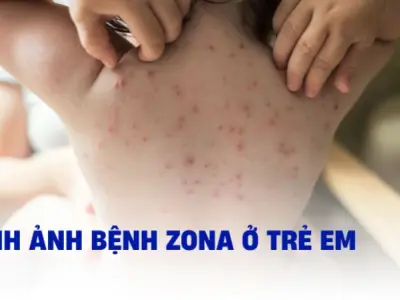 Cập nhật hình ảnh bệnh zona ở trẻ em mới nhất hiện nay