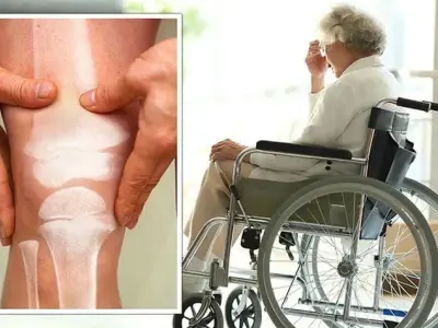 Khám phá ảnh bệnh bại liệt ấn tượng giúp nhận biết nhanh chóng