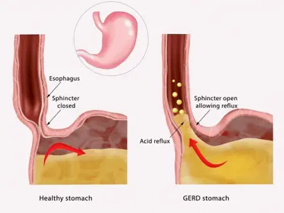 Trào ngược dạ dày thực quản là gì và bộ tranh tô màu cho bé